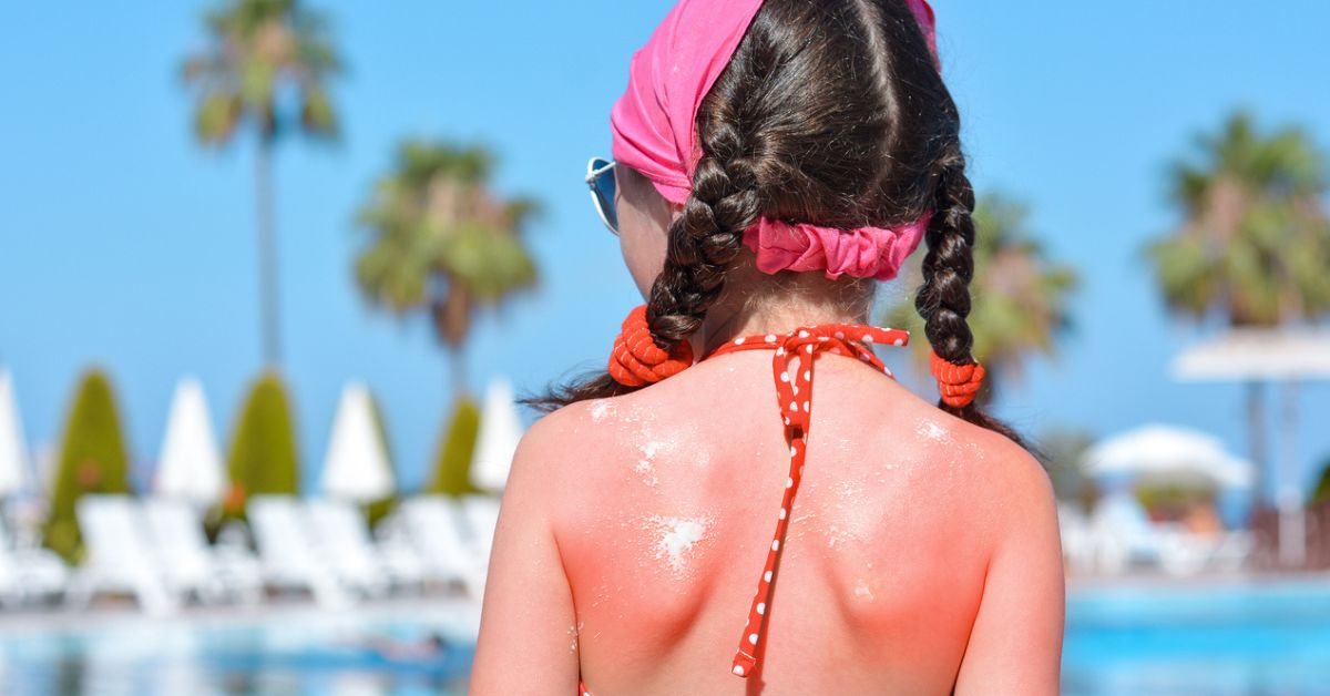 What Do I Do If My Child Gets Sun Poisoning? Photo