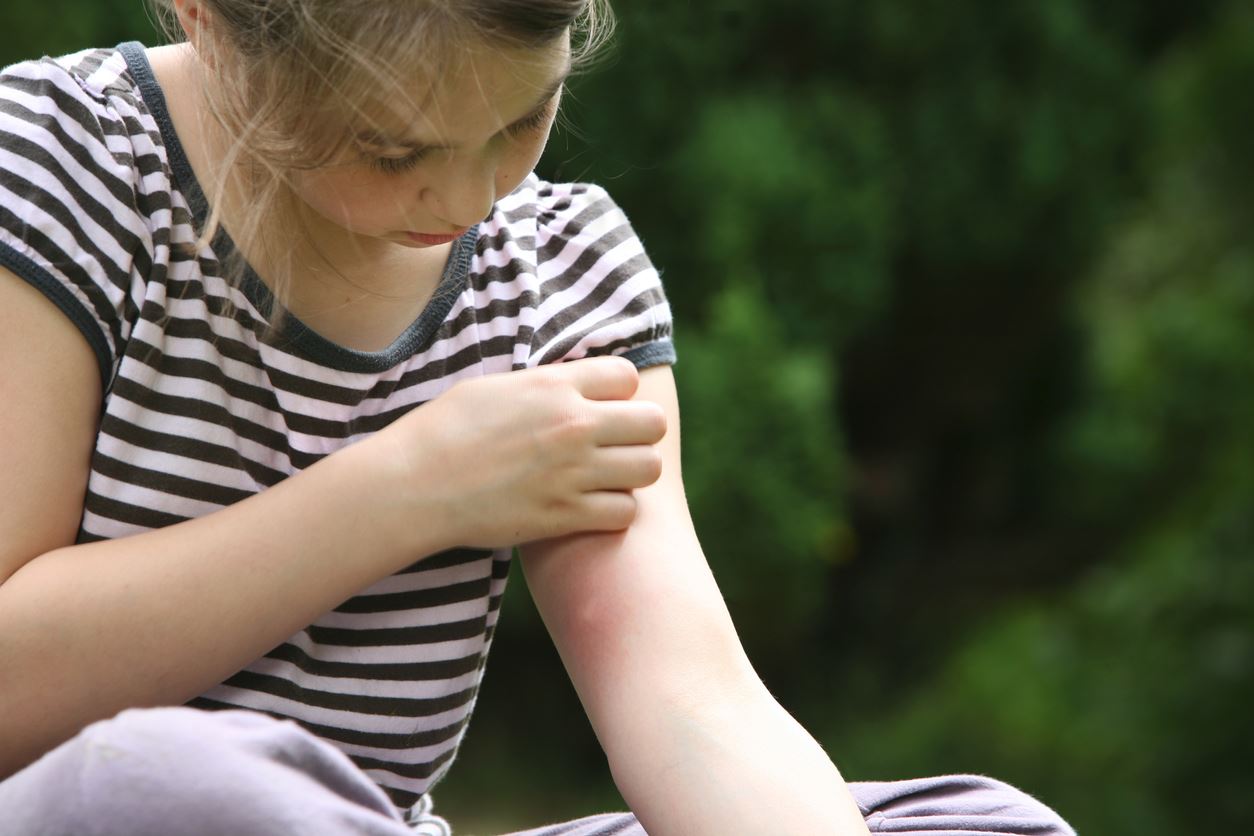 Allergies to Summer Insect Bites Photo